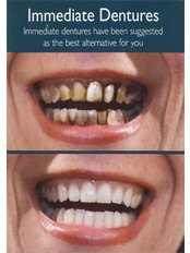 Immediate Dentures - Skourasdent Clinic