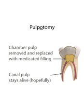 Pulpotomy - Skourasdent Clinic