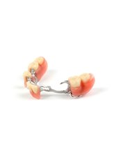 Chrome Dentures - Skourasdent Clinic