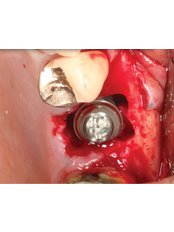 Immediate Implant Placement - Skourasdent Clinic