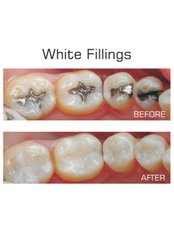 White Filling - Skourasdent Clinic