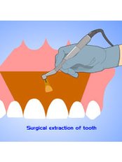 Surgical Extractions - Skourasdent Clinic