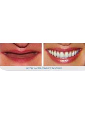 Full Dentures - Skourasdent Clinic
