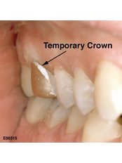 Temporary Crown - Skourasdent Clinic