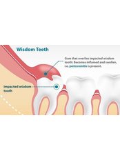 Wisdom Tooth Extraction - Skourasdent Clinic