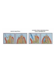 GTR - Guided Tissue Regeneration - Skourasdent Clinic
