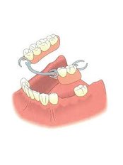 Removable Partial Dentures - Skourasdent Clinic