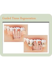 GTR - Guided Tissue Regeneration - Skourasdent Clinic