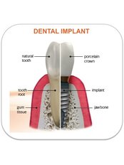 Implant Dentist Consultation - Skourasdent Clinic