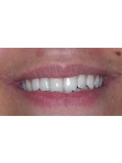 Teeth Whitening - Surgery in Greece - Dental Clinic