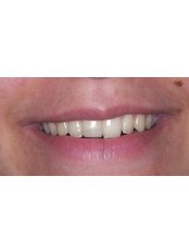 Teeth Whitening - Surgery in Greece - Dental Clinic