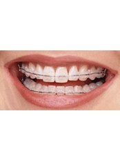 Ceramic Braces - Your Smile Orthodontics