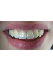 Teeth Contouring and Reshaping - orthoESTHITIKI