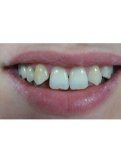 Teeth Contouring and Reshaping - orthoESTHITIKI