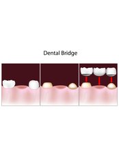 Dental Bridges - Gentle Dental Clinic - Crete