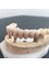 Gentle Dental Clinic - Crete - Full round dental porcelain bridge on 4 dental implants 
