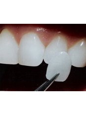 Veneers - Gentle Dental Clinic - Crete