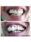 Gentle Dental Clinic - Crete - Full mouth restoration with dental implants and porcelain  crowns. 
