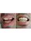 Gentle Dental Clinic - Crete - Full mouth restoration with porcelain crowns 