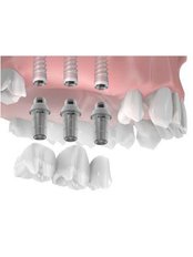 Dental Implants - Athens Oral Surgery - Athena Spanos, MD. DDS
