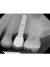Single Dental Implant - Athens Oral Surgery - Athena Spanos, MD. DDS