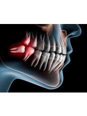 Wisdom Tooth Extraction - Athens Oral Surgery - Athena Spanos, MD. DDS