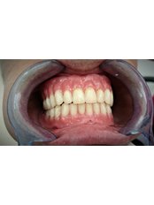 Acrylic Dentures - Lyro Dental Clinic Single Member P.C.