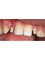 Your Smile Dental Care - implants zirconium 