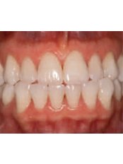 Teeth Whitening - Brokos Clinic