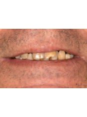 Dental Implants - Brokos Clinic