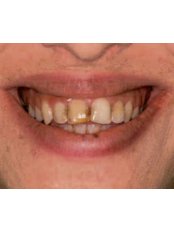 Dental Crowns - Brokos Clinic