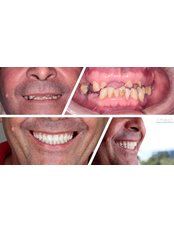 All-on-4 Dental Implants - Clinident