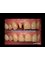 Denti Vitale Especialidades Dentales - all ceramic crowns 
