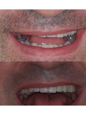 Veneers - Especialistas Dentales Internacional/ Dental Specialist International