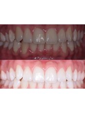 Teeth Whitening - Especialistas Dentales Internacional/ Dental Specialist International