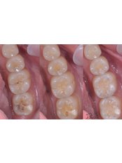 Fillings - Especialistas Dentales Internacional/ Dental Specialist International