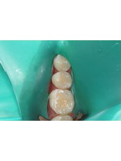 Composite Resin Inlay or Onlay - Guatemala Dental
