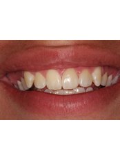 Veneers - Guatemala Dental