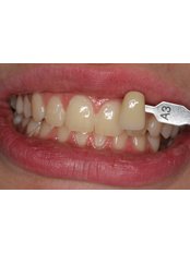Teeth Whitening - Guatemala Dental