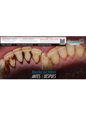 Teeth Cleaning - Guatemala Dental