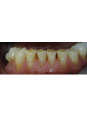 Zirconia Crown - Guatemala Dental