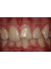 Veneers - Guatemala Dental