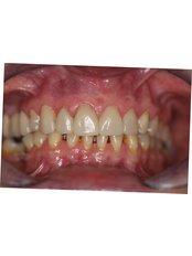 Dental Crowns - Guatemala Dental