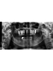 Dental Implants - Hazbun Dental