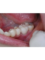 Dental Implants - The Hong Kong Japanese Dental Clinic