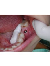 Dental Implants - The Hong Kong Japanese Dental Clinic