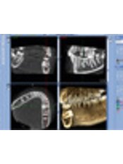 Panoramic Dental X-Ray - Affordable Dentist at WestDent