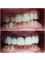 Hungary Dental Implant - Budapest - E.max veneers_before-after2 