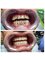 Hungary Dental Implant - Budapest - E.max veneers_before-after1 