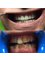 Hungary Dental Implant - Budapest - Zirconium-Ceramic crowns_before-after2 